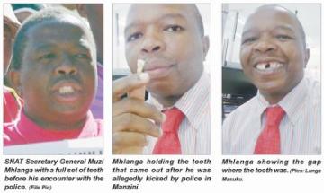 Unionist in Swaziland demand E1 million for lost tooth